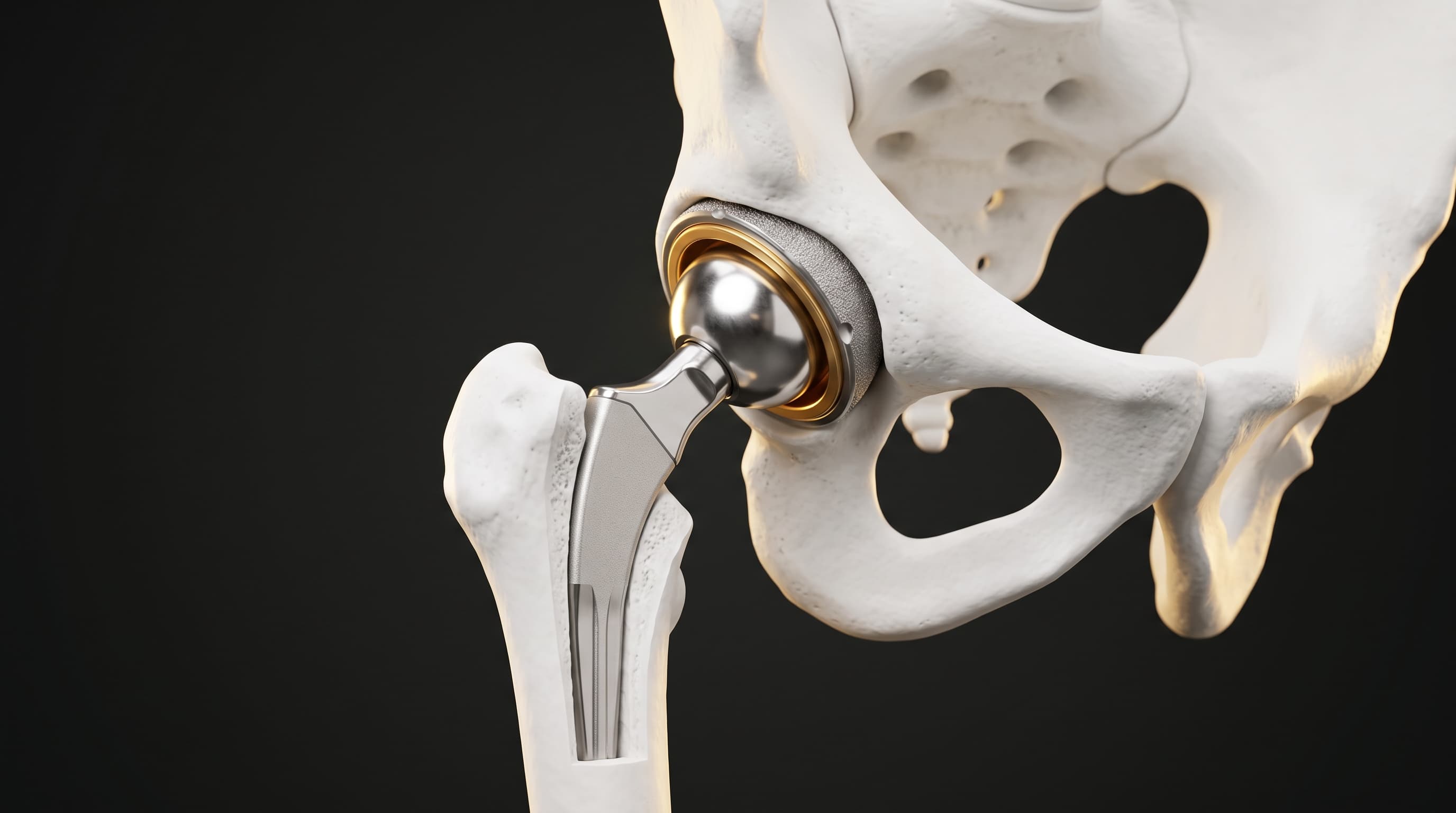Prótesis y Reemplazo Total de Cadera (Artroplastia de Cadera)